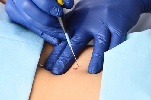 Dermato-surgery Dr. Prratyush More Thane