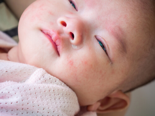 Paediatric dermatology consultation Dr. Prratyush More Thane