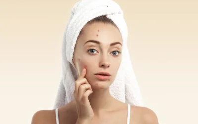 Why Do Some People Continue Getting Acne Well Into Adulthood?