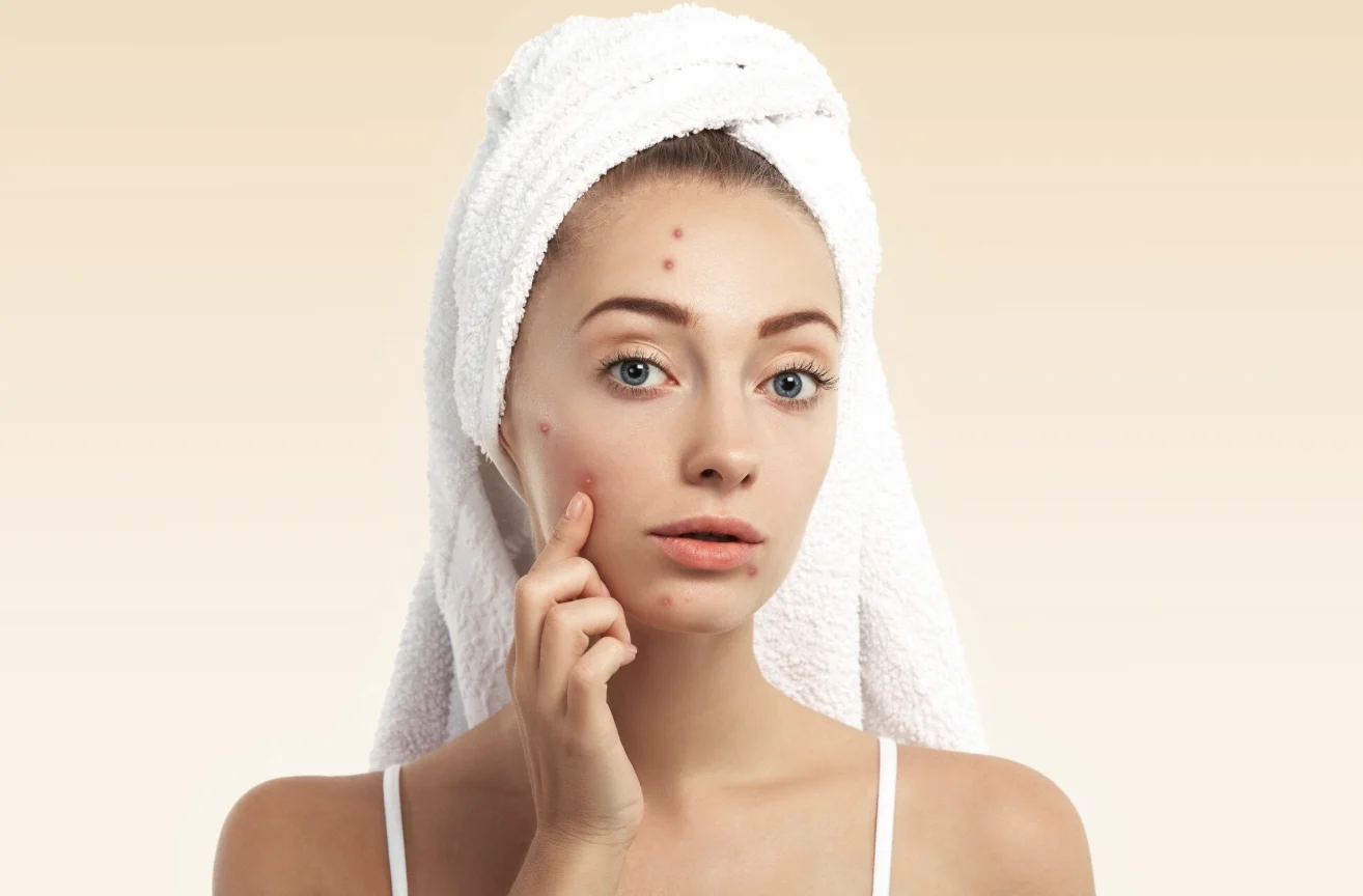Why Do Some People Continue Getting Acne Well Into Adulthood?