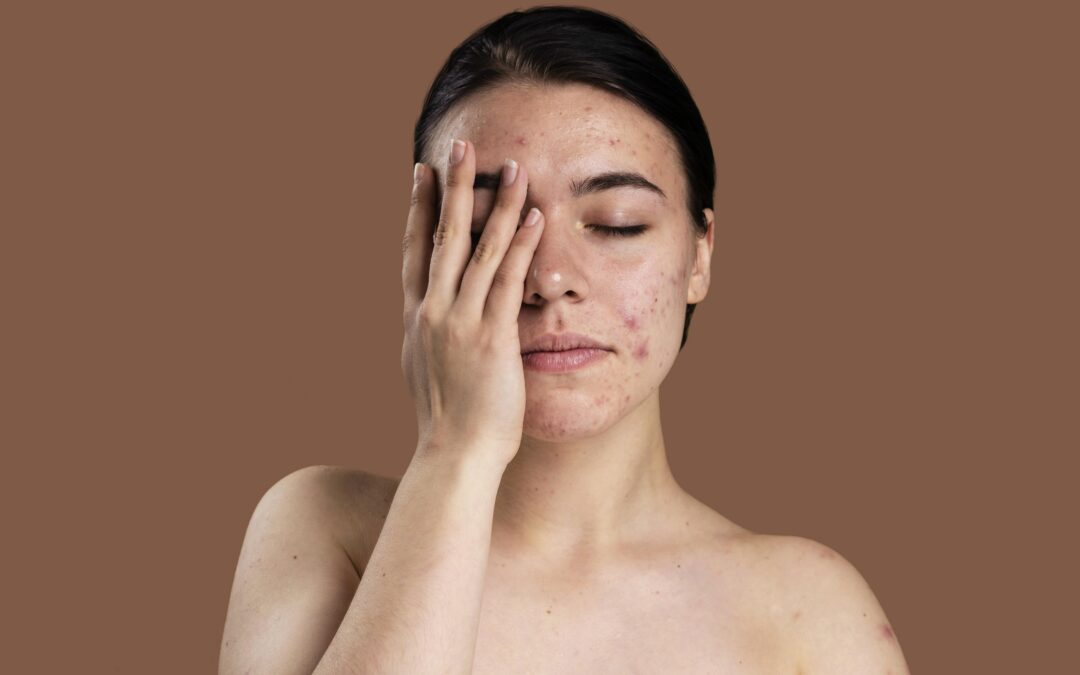 Pigmentation Disorders: Causes, Types & How Dermatologists Treat Them